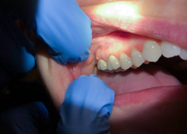 Best Emergency Root Canal Treatment in Newaygo, MI