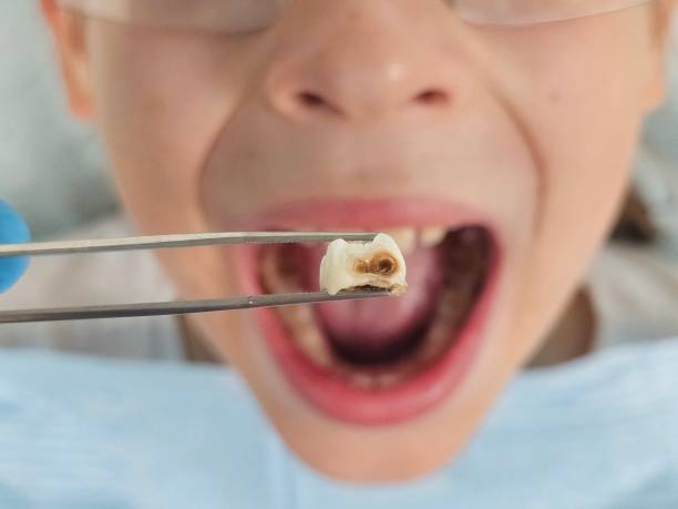 Best Emergency Tooth Extraction in Newaygo, MI